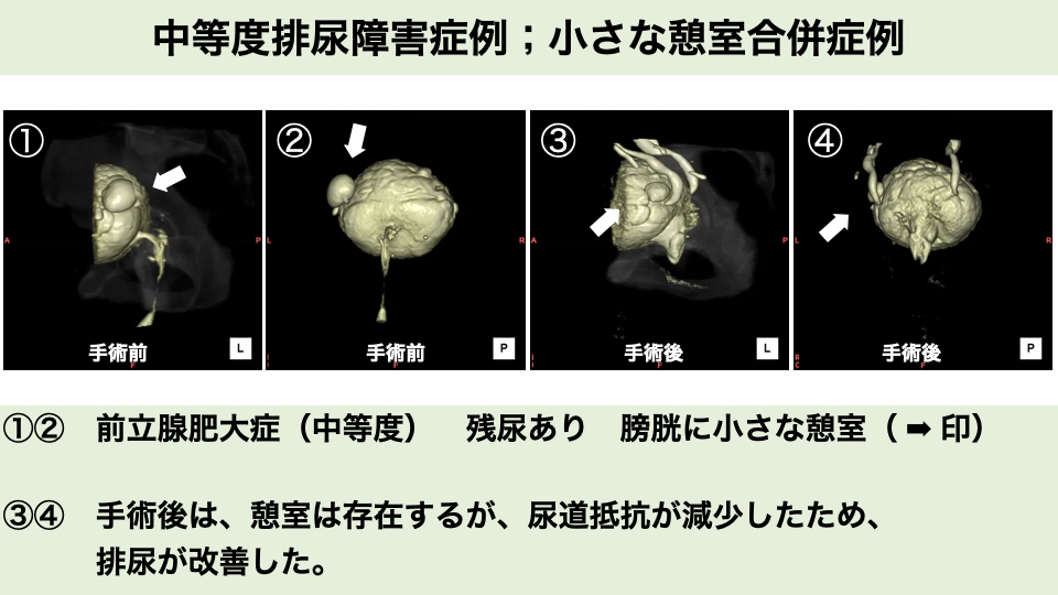 残尿もある症例