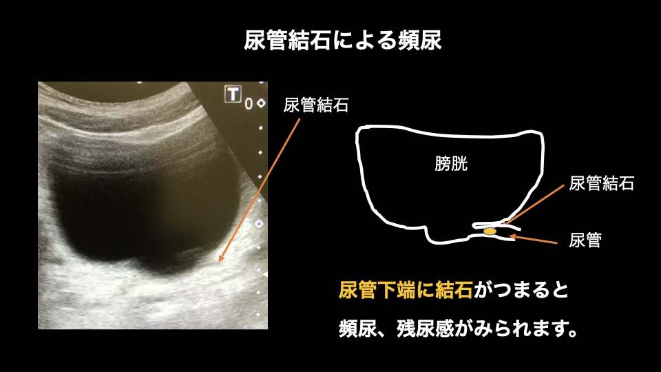 尿管下端結石