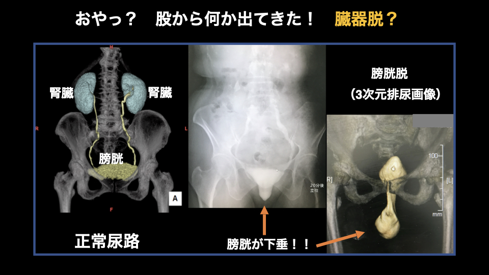 骨盤臓器脱