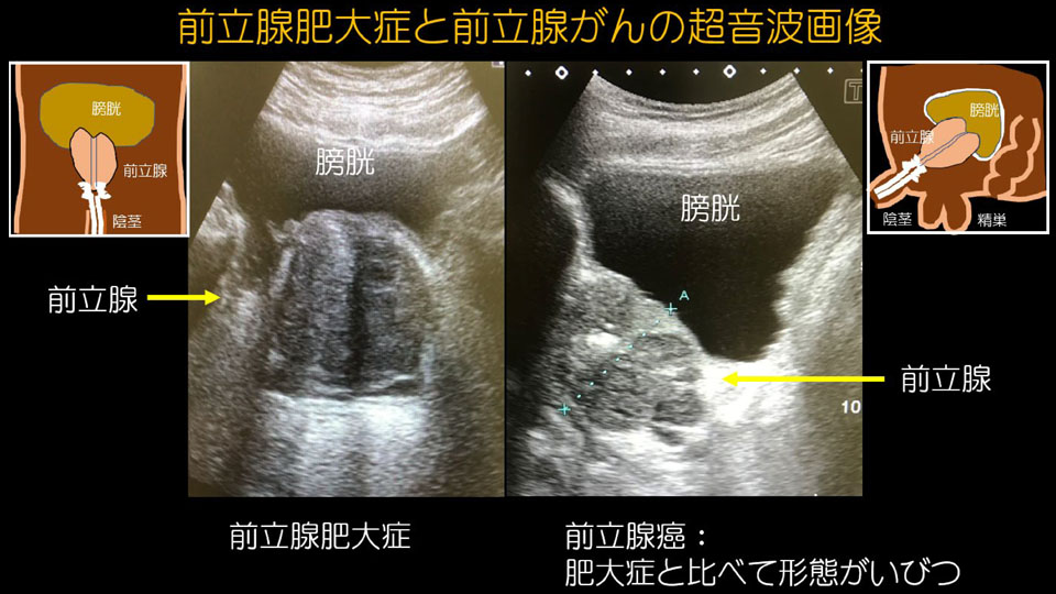 前立腺がんの可能性も考えます。