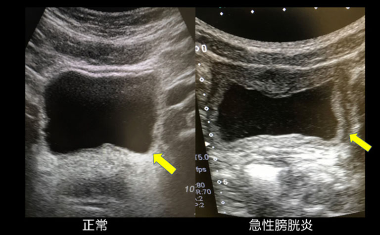 急性膀胱炎